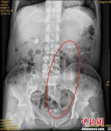 四川一男子體內(nèi)藏30厘米醫(yī)用導(dǎo)管七年渾然不知（圖）